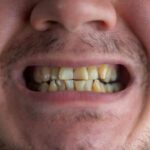 How to Remove Coffee Stains on Your Teeth