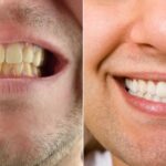 Remove Coffee Stains From Your Teeth